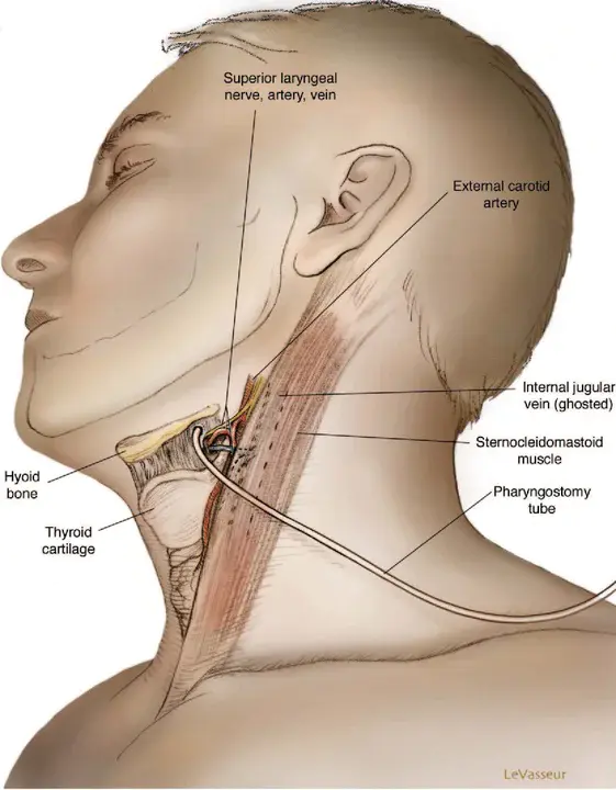 partial laryngopharyngectomy : 部分喉咽切除术