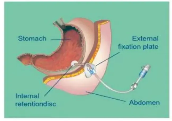 Percutaneous Dilatational Tracheostomy : 经皮扩张气管造口术