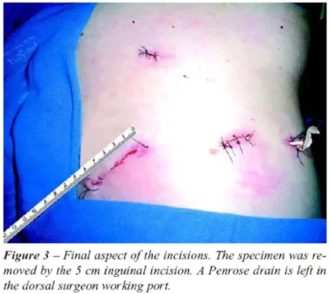 Percutaneous Renal Biopsy : 经皮肾活检