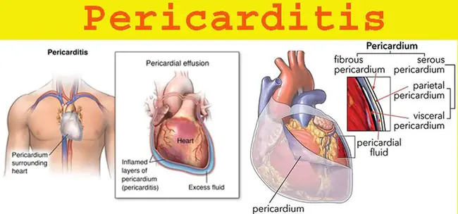 pericarditis : 心包炎