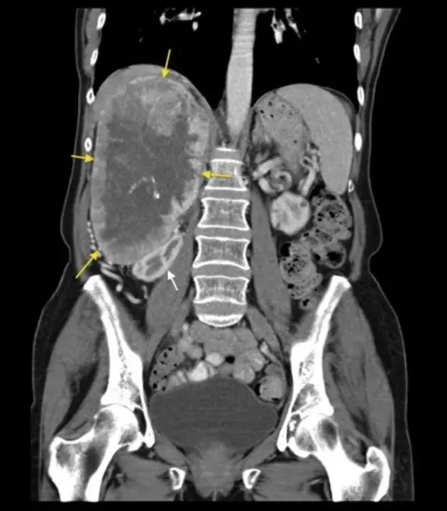 phaeochromocytoma : 嗜铬细胞瘤