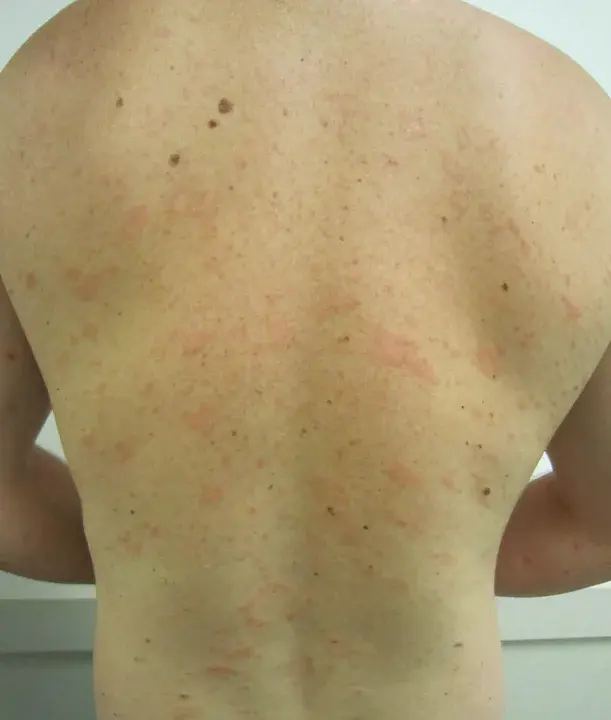 Pityriasis Rosea : 玫瑰糠疹