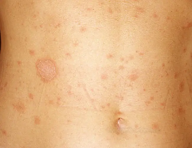 Pityriasis Rubra Pilaris : 毛发红糠疹