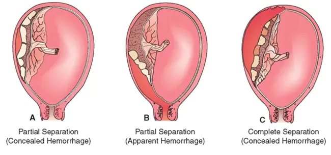 Placental Retention : 胎盘滞留