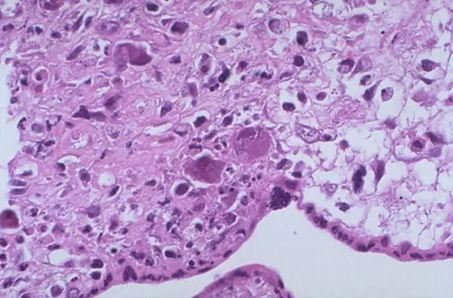 Placental Sulphatase Deficiency : 胎盘硫酸酯酶缺乏