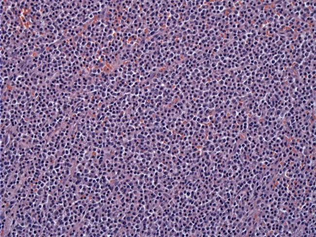 Plasma Cell Granuloma : 浆细胞肉芽肿