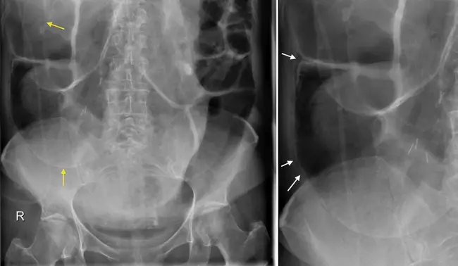 Pneumatosis Cystoides Coli : 肺囊状瘤