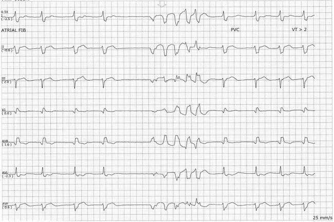 polymorphic reticulosis : 多态性网状组织增生