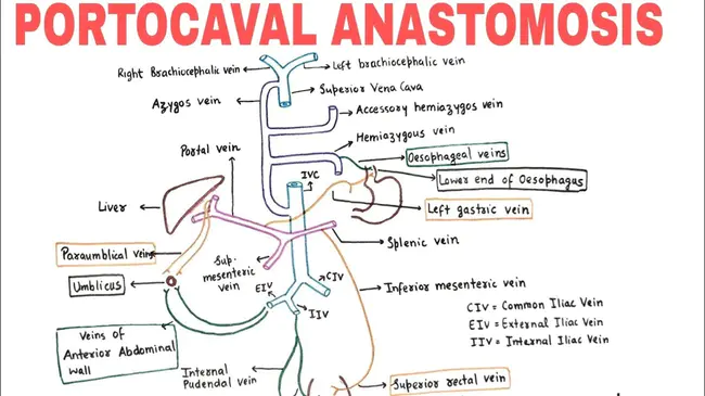 portocaval : 门腔静脉的