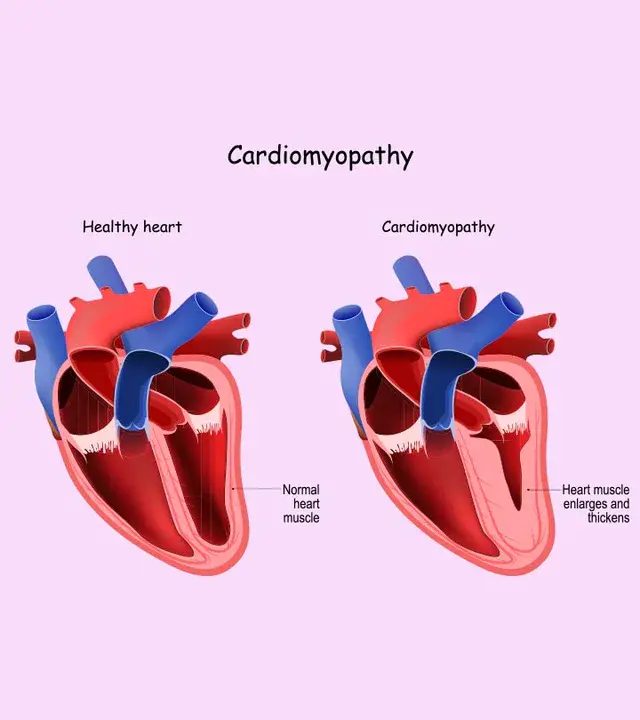 postpericardiotomy syndrome : 心包切开术后综合征