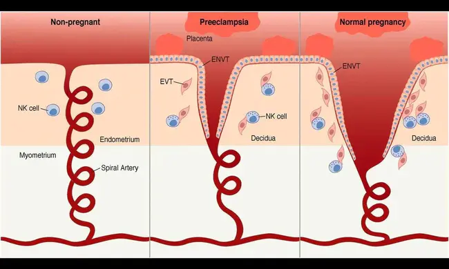 Pre-Eclampsia : 先兆子痫