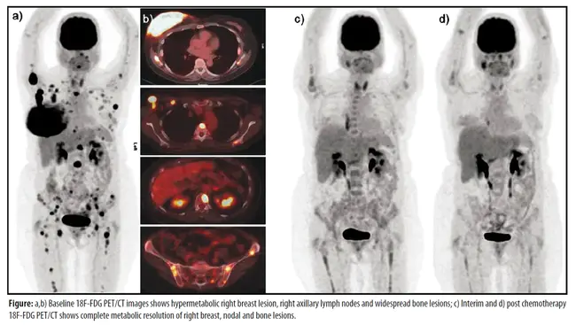 Primary Breast Lymphoma : 原发性乳腺恶性淋巴瘤