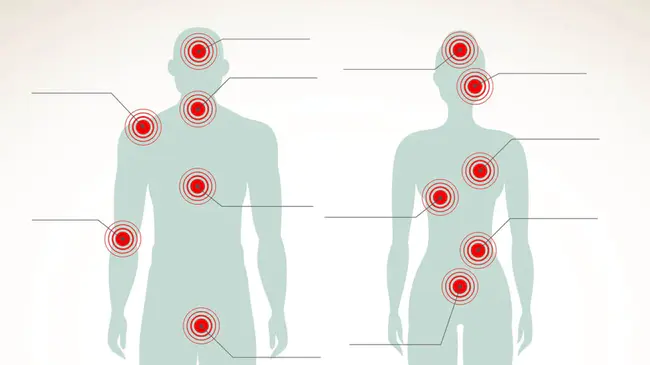 Primary Fibromyalgia : 原发性纤维肌痛