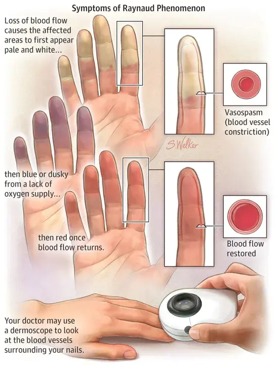 primary Raynaud phenomenon : 原发性雷诺现象