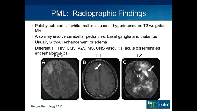 Progressive Pigmentary Retinopathy : 渐进性色素性视网膜病变