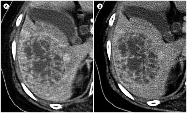 Proliferative Enteropathy : 增殖性肠病