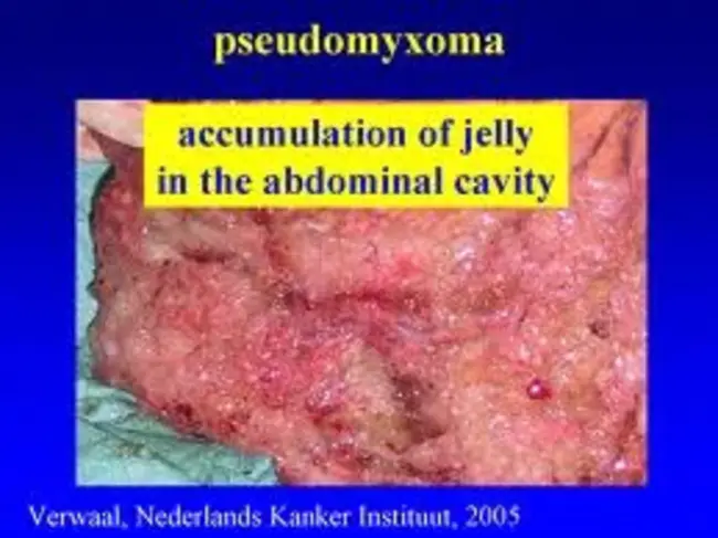 Pseudomyxoma Peritonei : 腹膜假粘液瘤