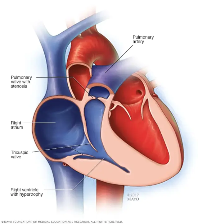 Pulmonary Arteriovenous Fistula : 肺动静脉瘘