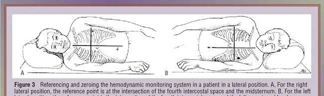 Pulmonary Artery Mean Pressure : 肺动脉平均压