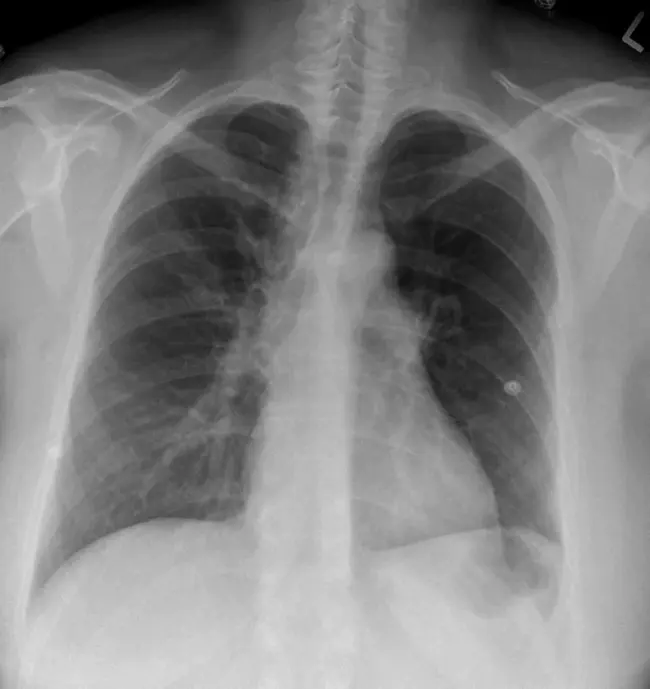 Pulmonary Capillary : 肺毛细血管