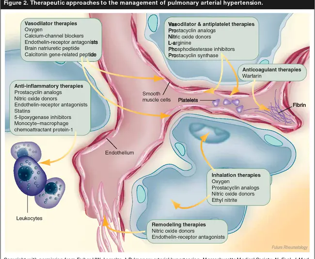 Pulmonary Ejection Click : 肺射血点击