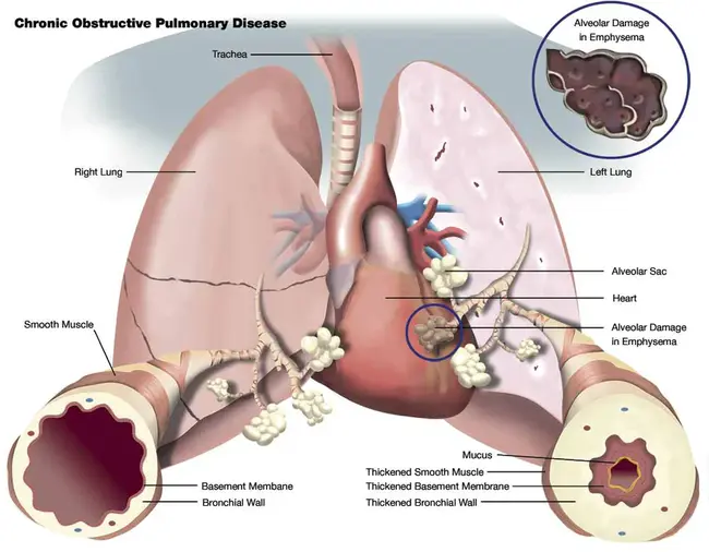 Pulmonary Embolectomy : 肺栓塞切除术