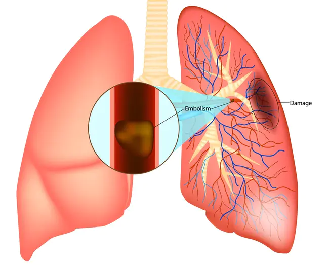 Pulmonary Embolus : 肺栓塞