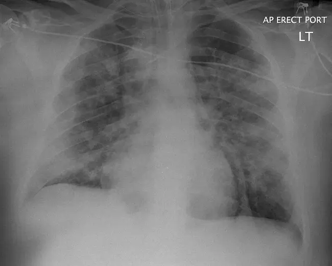 Pulmonary Index : 肺指数