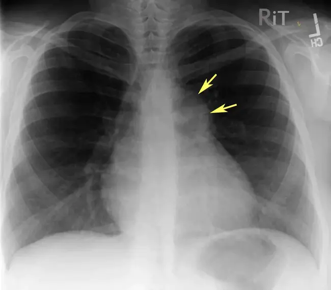 Pulmonary Stenosis : 肺动脉狭窄