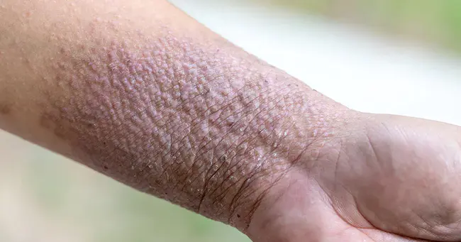 Pustular Psoriasis : 脓疱性银屑病