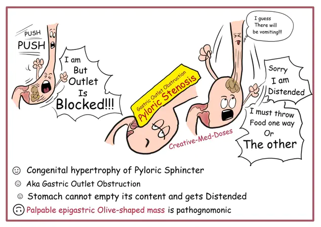 Pyloric Stenosis : 幽门狭窄