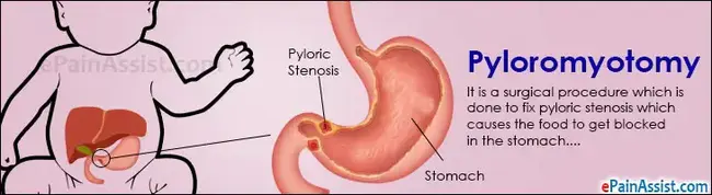 pyloromyotomy : 幽门肌切开术