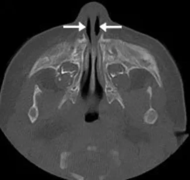 Pyriform Sinus : 梨状窦