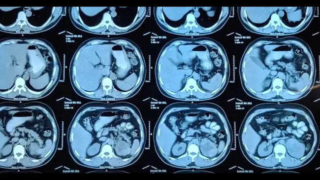 Radical Nephrectomy : 根治性肾切除术