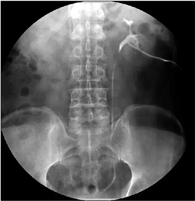 radiocontrast nephropathy : 放射性造影肾病