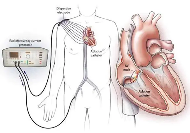 Radiofrequency Catheter Ablation : 射频导管消融