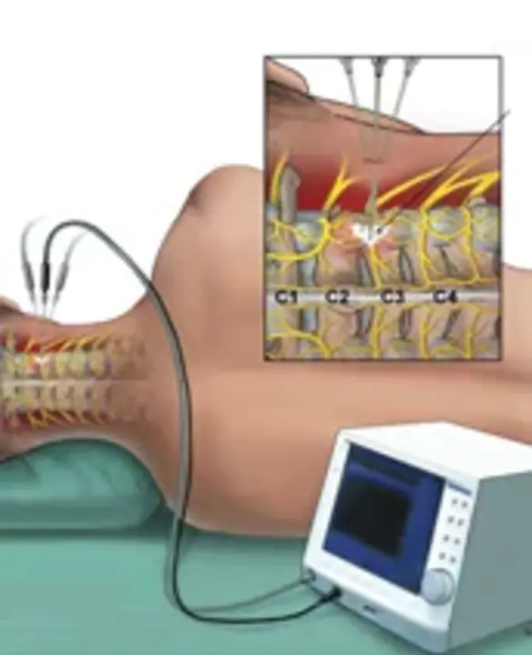 radiofrequency coagulation : 射频凝固