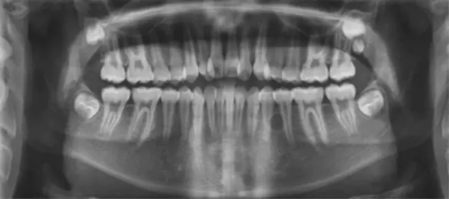 Radiographic Absorptiometry : 射线吸收法