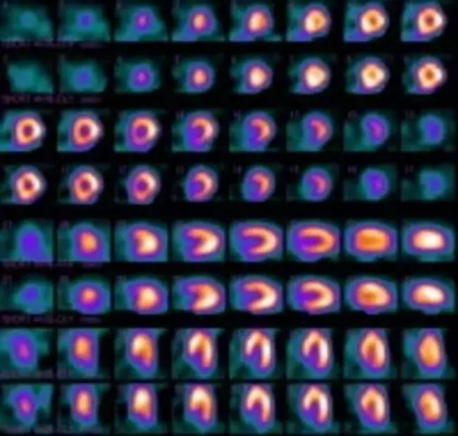 Radionuclide Angiography : 放射性核素血管造影