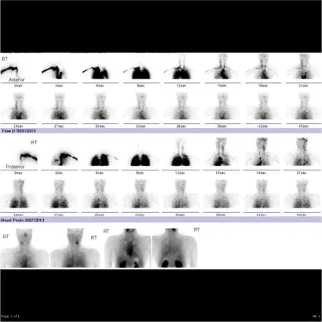 Radionuclide Esophageal Scintigraphy : 放射性核素食管闪烁扫描术