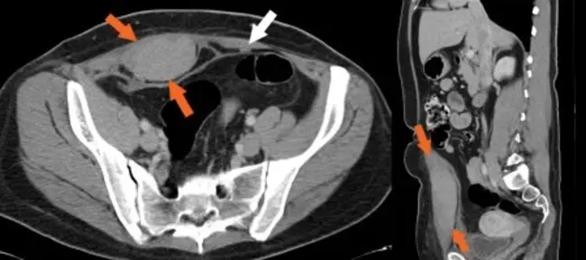 Rectus Sheath Haematoma : 直肌鞘血肿