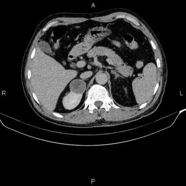 Renal Cell Adenoma : 肾细胞腺瘤