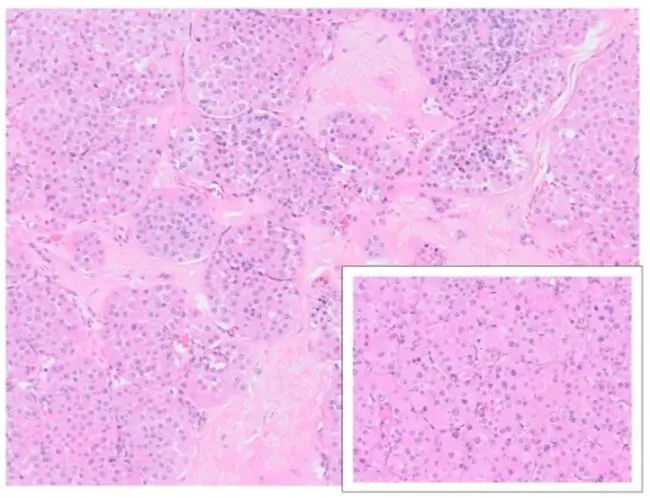 Renal Oncocytoma : 肾癌细胞瘤