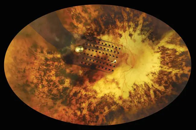 Retinal Thickness Analysis : 视网膜厚度分析