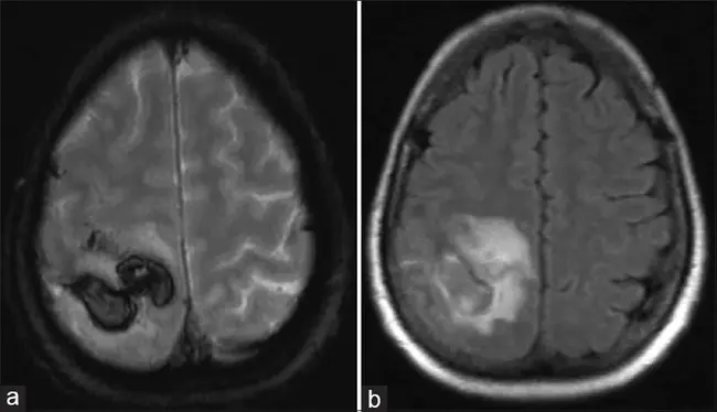 Retrograde Cerebellar Perfusion : 逆行小脑灌注