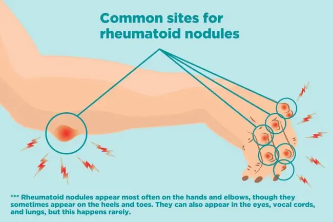 Rheumatoid Nodule : 类风湿结节