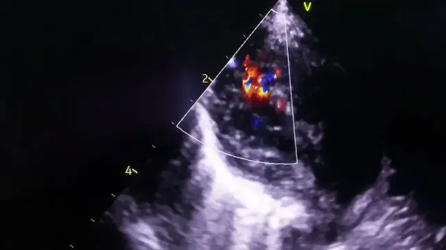 Right Coronary Angiography : 右冠状动脉造影