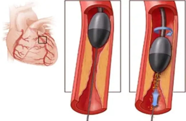 Rotational Coronary Atherectomy : 冠状动脉旋转切除术