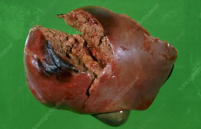 Ruptured Chordae Tendineae : 腱索断裂