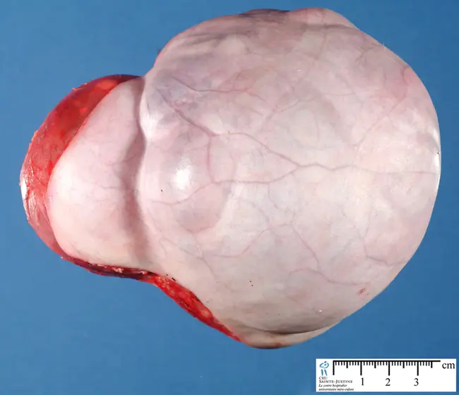 sacrococcygeal teratoma : 骶尾部畸胎瘤